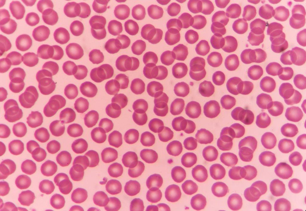 Normal red-blood cells under the microscope