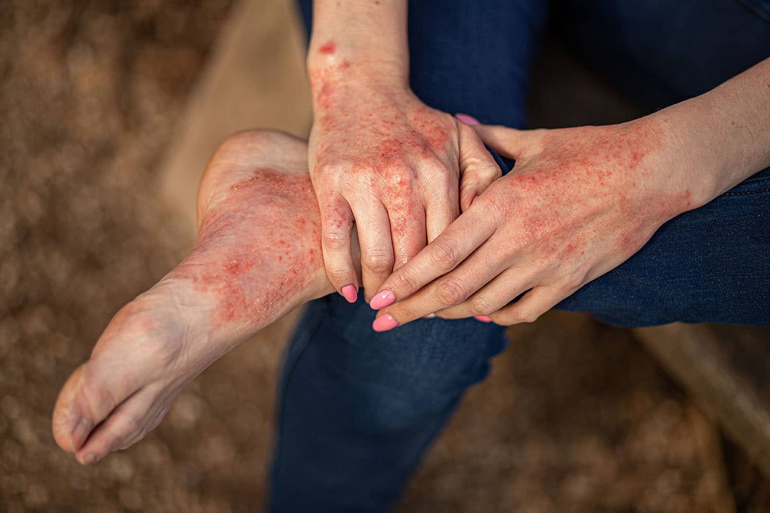 Eczema dermatitis on hands and feet.