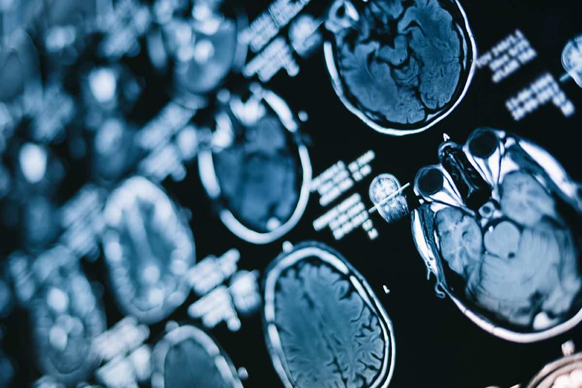 Close-up of CT scan with brain.