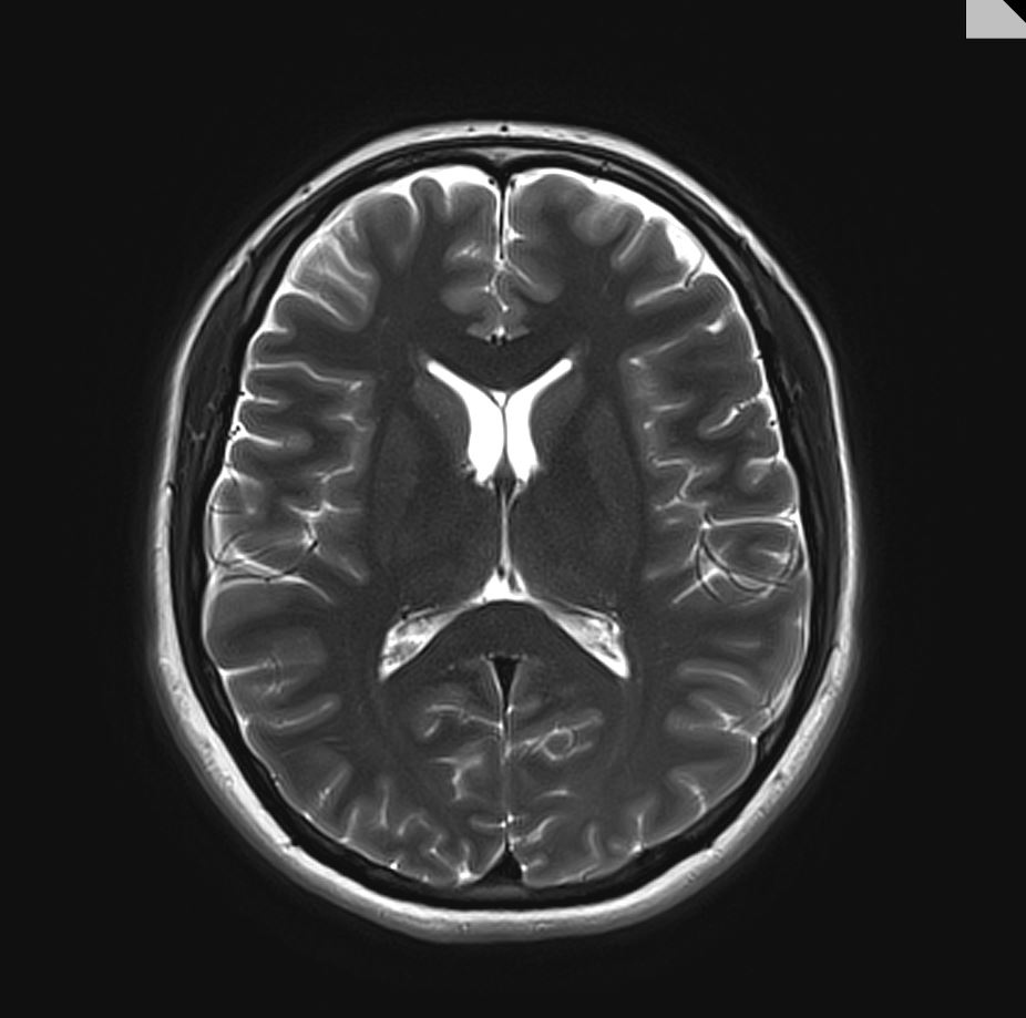 Picture of a brain scan from University of Edinburgh